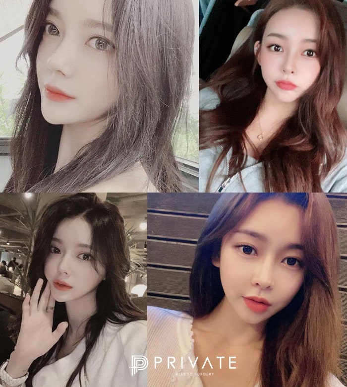 신사역 코성형외과유명한곳 프라이빗성형외과 사진 6