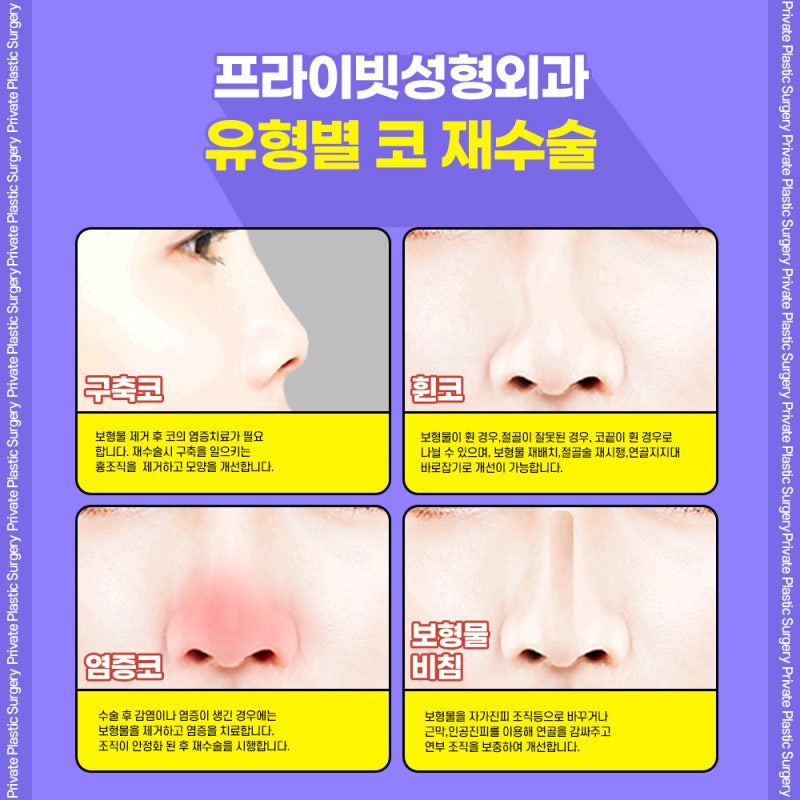 마지막 코재수술의 마침표, 프라이빗성형외과 사진 5