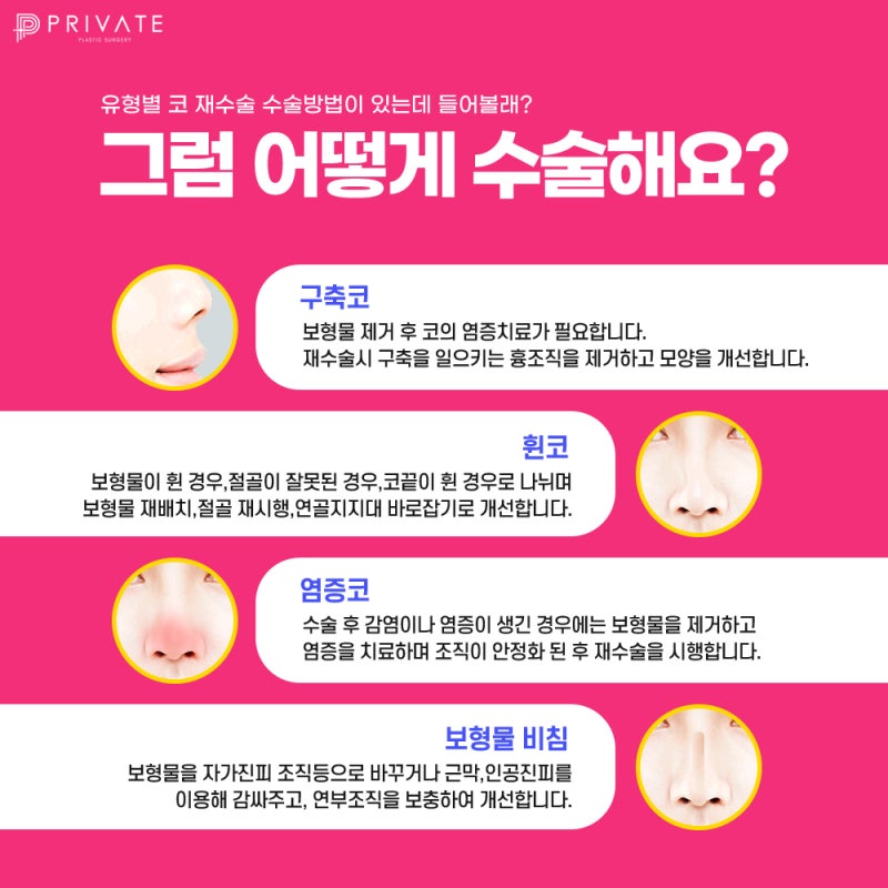 프라이빗성형외과 코재수술 신중하게. 사진 4