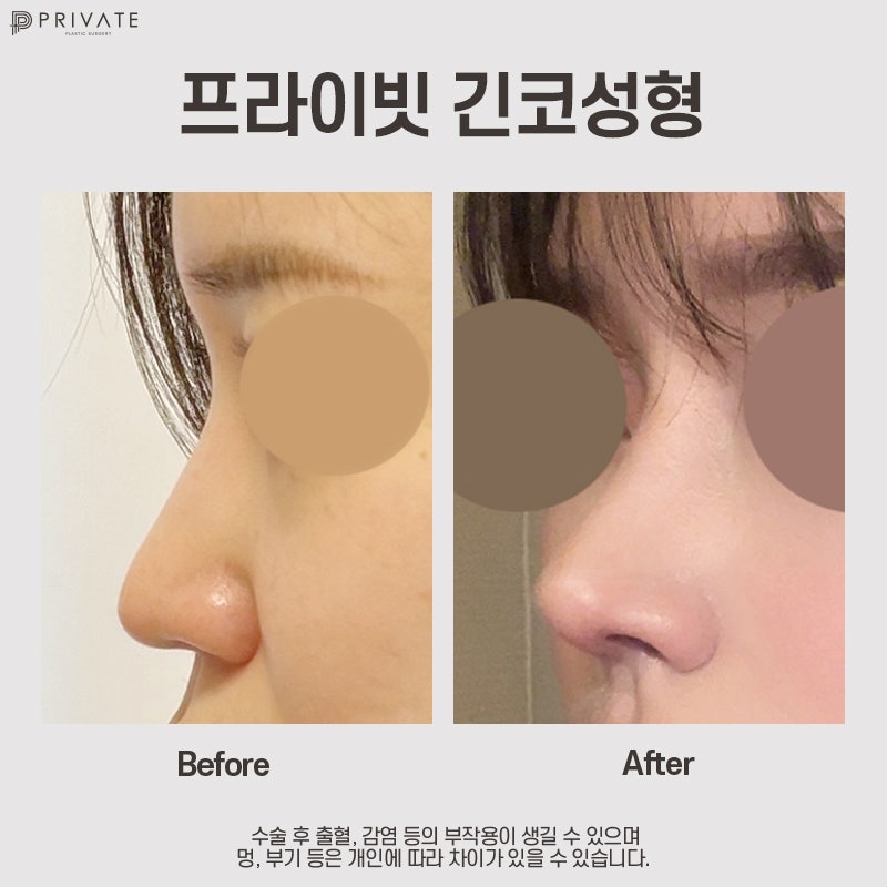 긴코성형유명한병원 프라이빗성형외과 사진 7