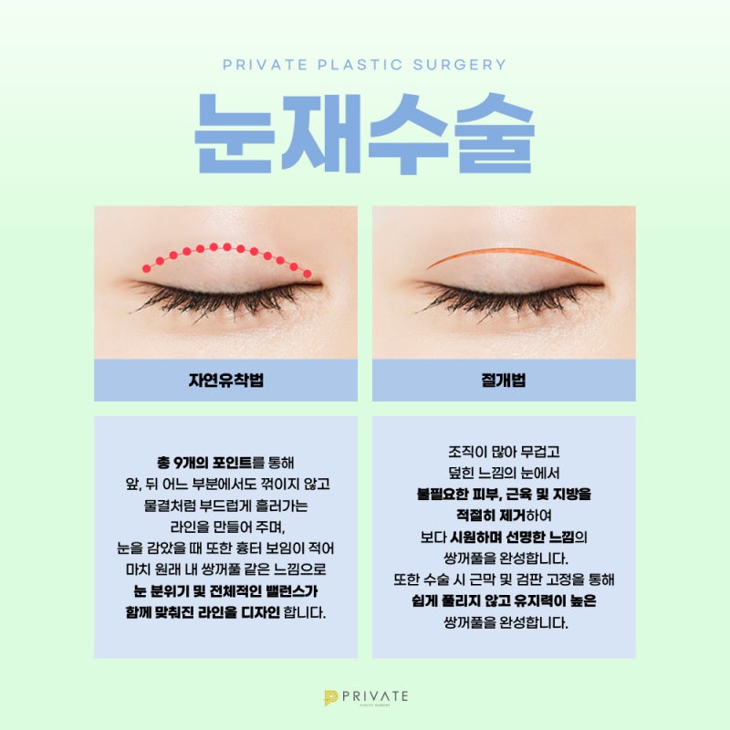 눈재수술성형 비율에 맞는 라인으로, 프라이빗성형외과 사진 4