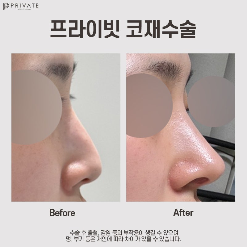 코재수술 프라이빗성형외과 후기 사진 8