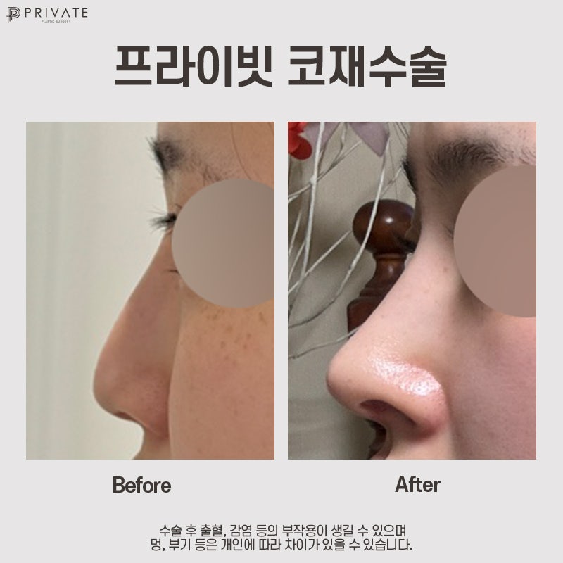 코재수술 프라이빗성형외과 후기 사진 2
