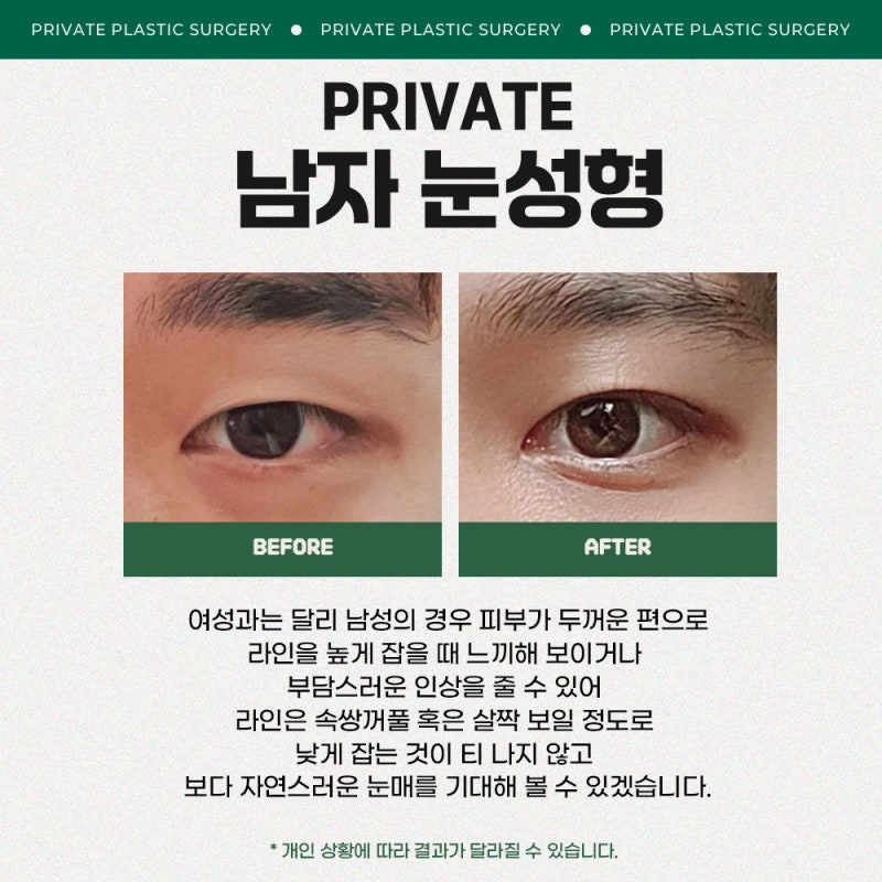 남자눈성형수술후기는 프라이빗성형외과
