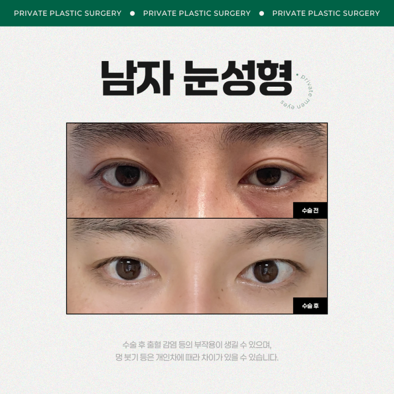 남자눈성형수술후기는 프라이빗성형외과 사진 5