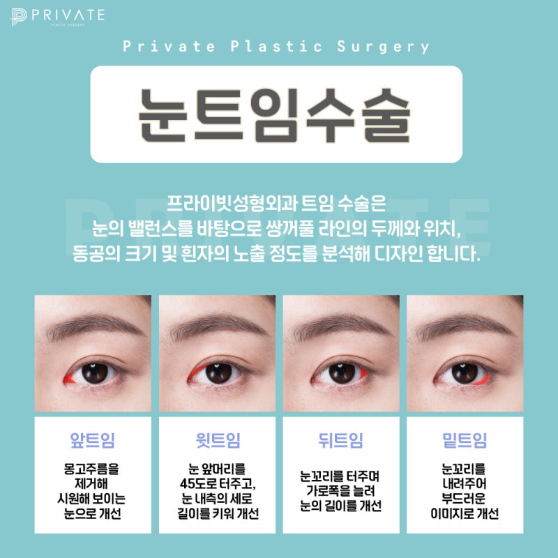 눈트임성형수술로 시원한눈매 완성, 프라이빗성형외과