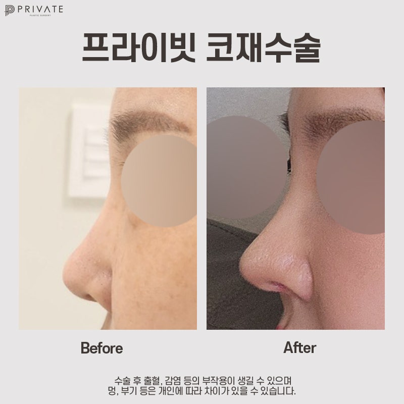 코재수술유명한병원은 프라이빗성형외과 사진 2