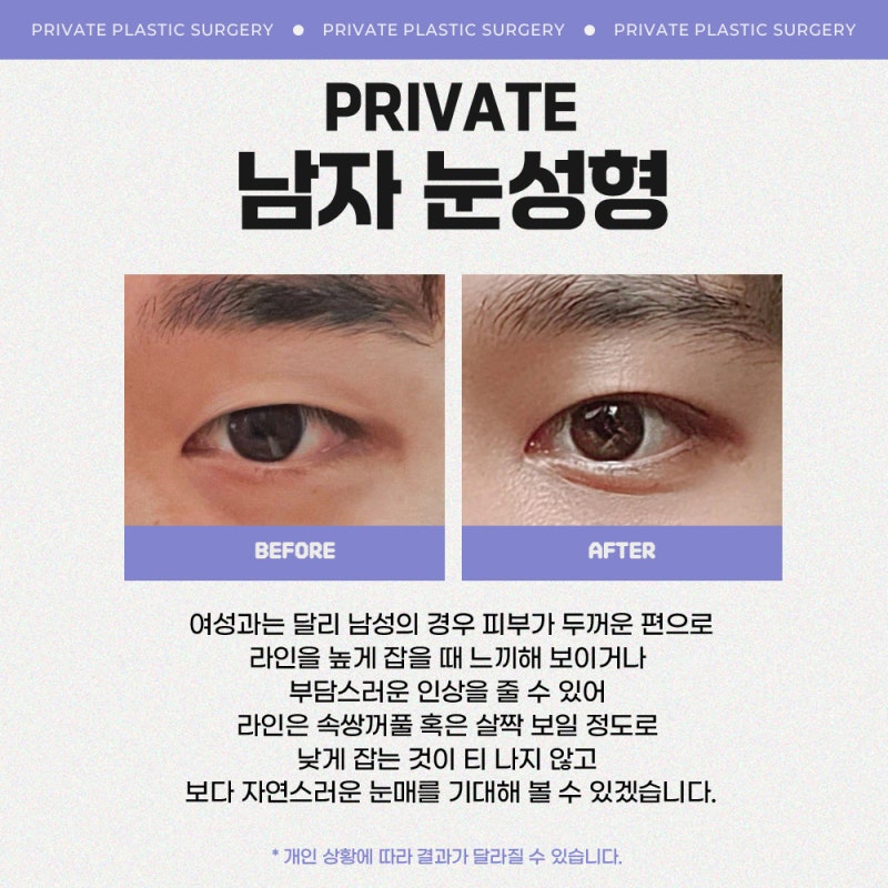 남자눈성형잘하는곳 프라이빗성형외과