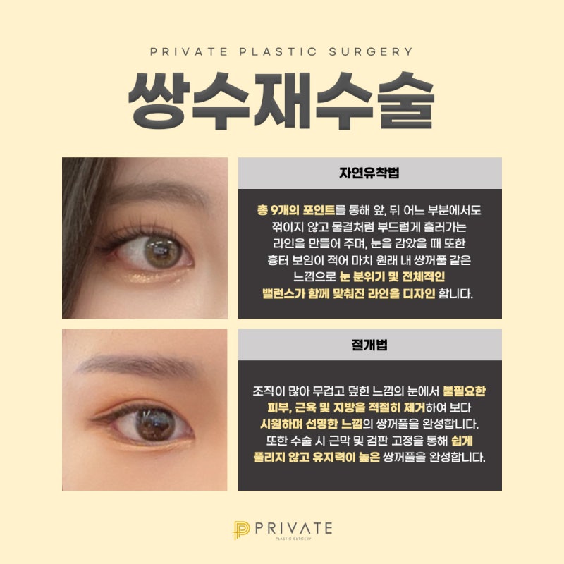 쌍수재수술후기 좋은곳 프라이빗성형외과 사진 4