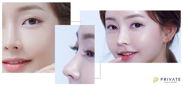 프라이빗성형외과 성형모델 주인공은 바로 당신 사진 6
