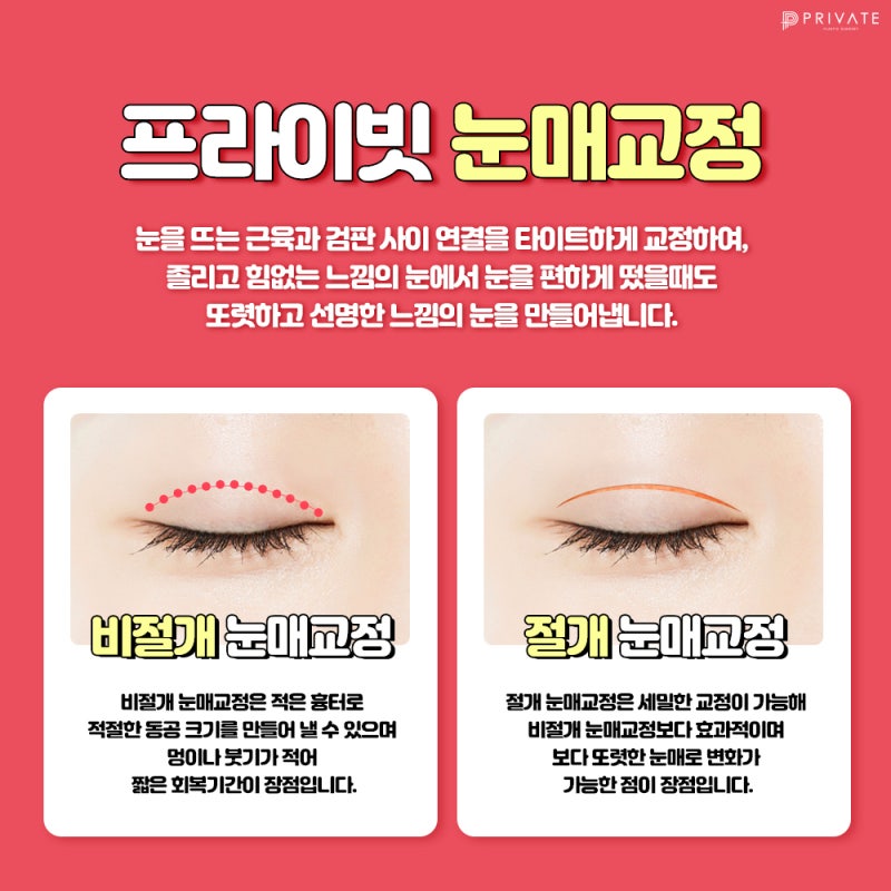 눈매교정쌍수잘하는병원은 프라이빗성형외과