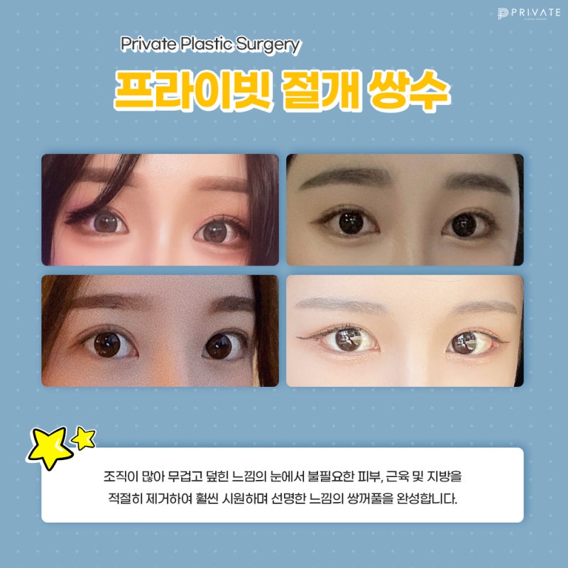 쌍꺼풀수술잘하는곳 여기잖아 사진 4