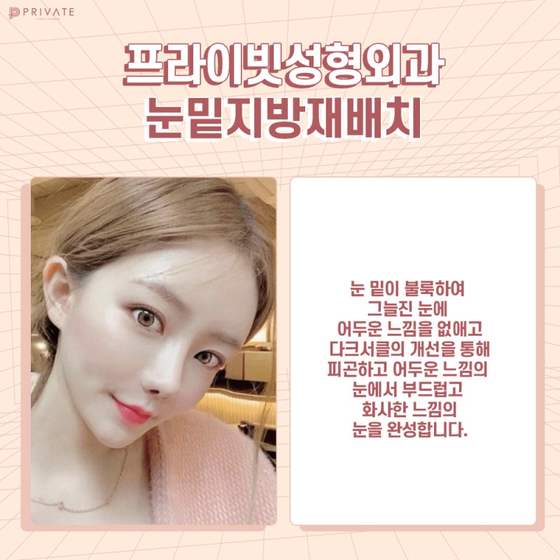눈밑지방재배치수술은 프라이빗성형외과