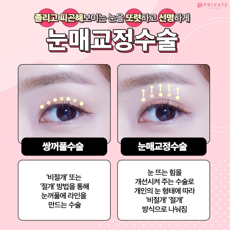 Koreksi Ptosis di Private Plastic Surgery 사진 4