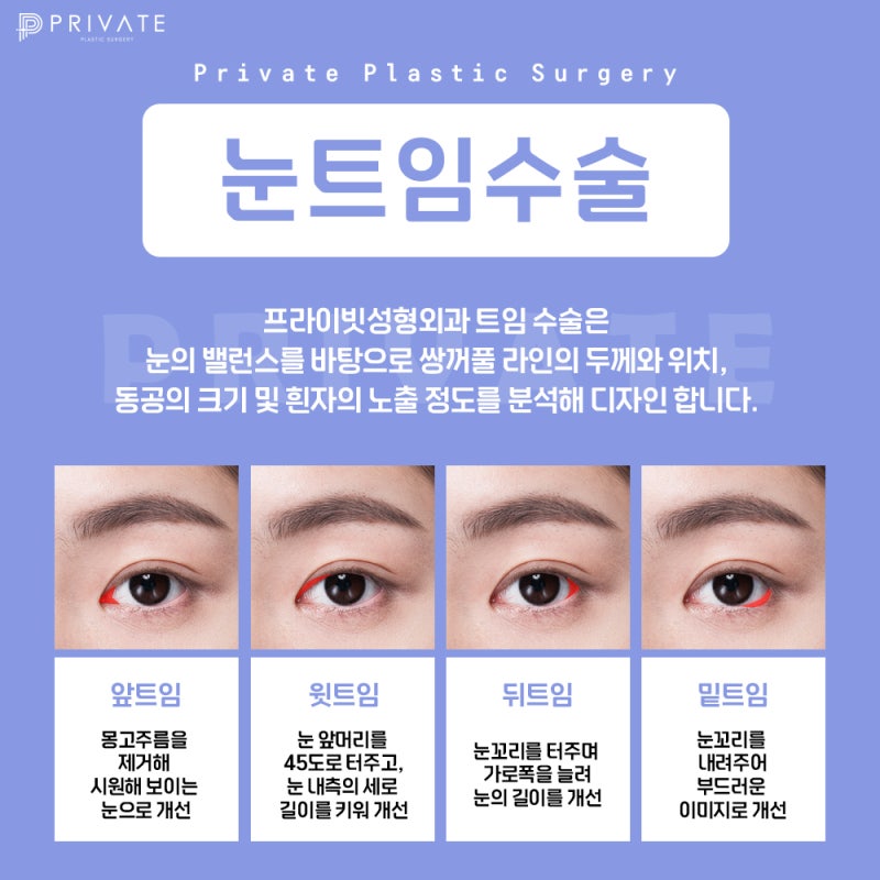 눈뒤밑트임잘하는곳 여기 프라이빗성형외과
