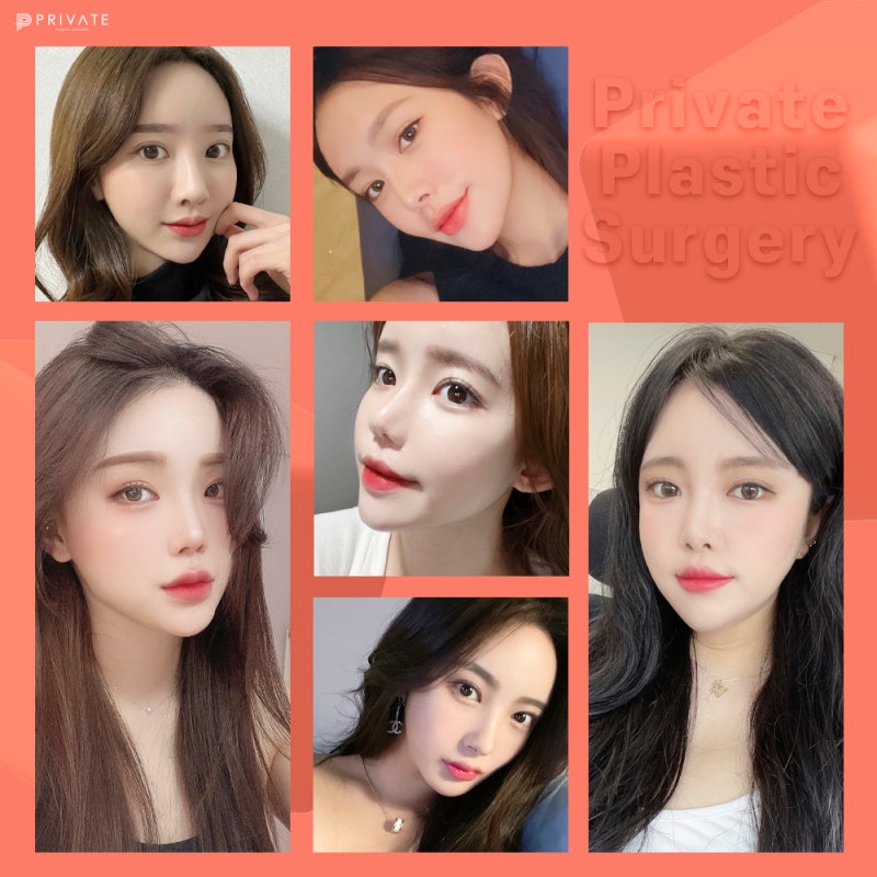 Operasi Rhinoplasty Tulang Rawan Rusuk Autologus di Private Plastic Surgery 사진 7