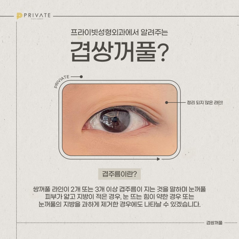프라이빗성형외과 겹쌍꺼풀수술 알아보기