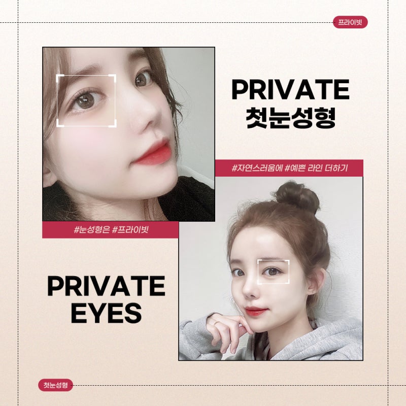 눈성형전후가 좋은 프라이빗성형외과 사진 7