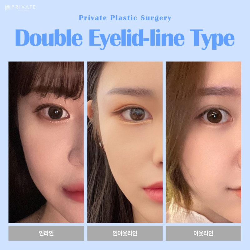 Tempat Terkenal untuk Operasi Mata Revisi adalah Private Plastic Surgery di Sinsa 사진 5