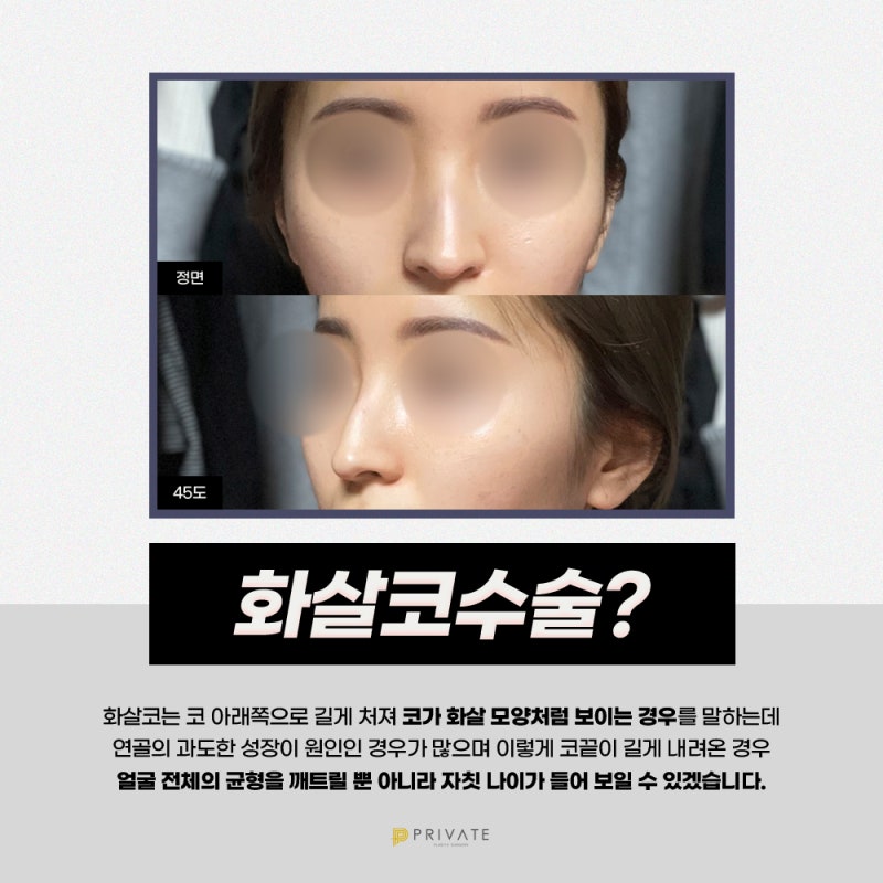 Operasi Hidung Panah di Sinsa Private Plastic Surgery