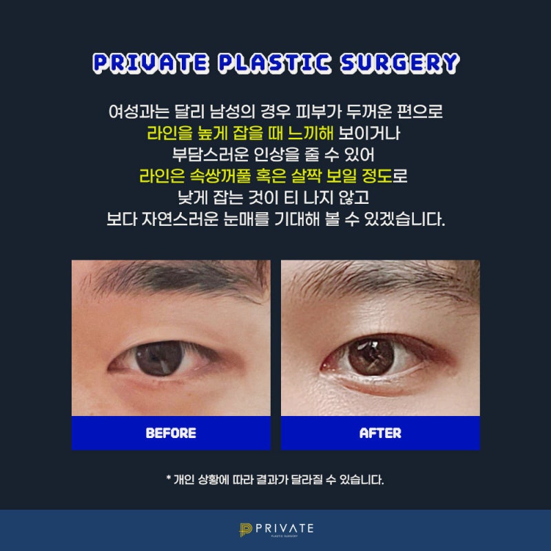 남자 쌍수 병원은 신사 프라이빗성형외과