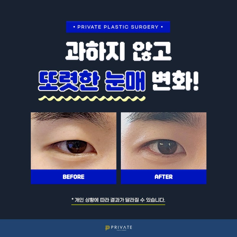 남자 쌍수 병원은 신사 프라이빗성형외과 사진 5