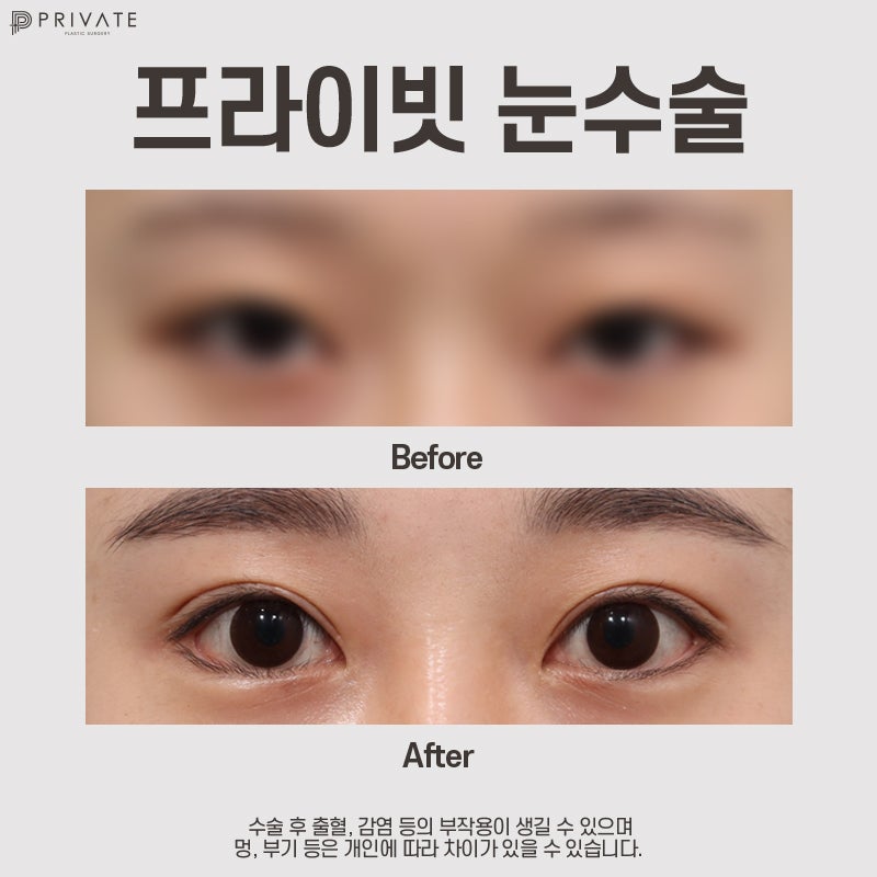 세미아웃라인 쌍꺼풀수술은 프라이빗성형외과 사진 7