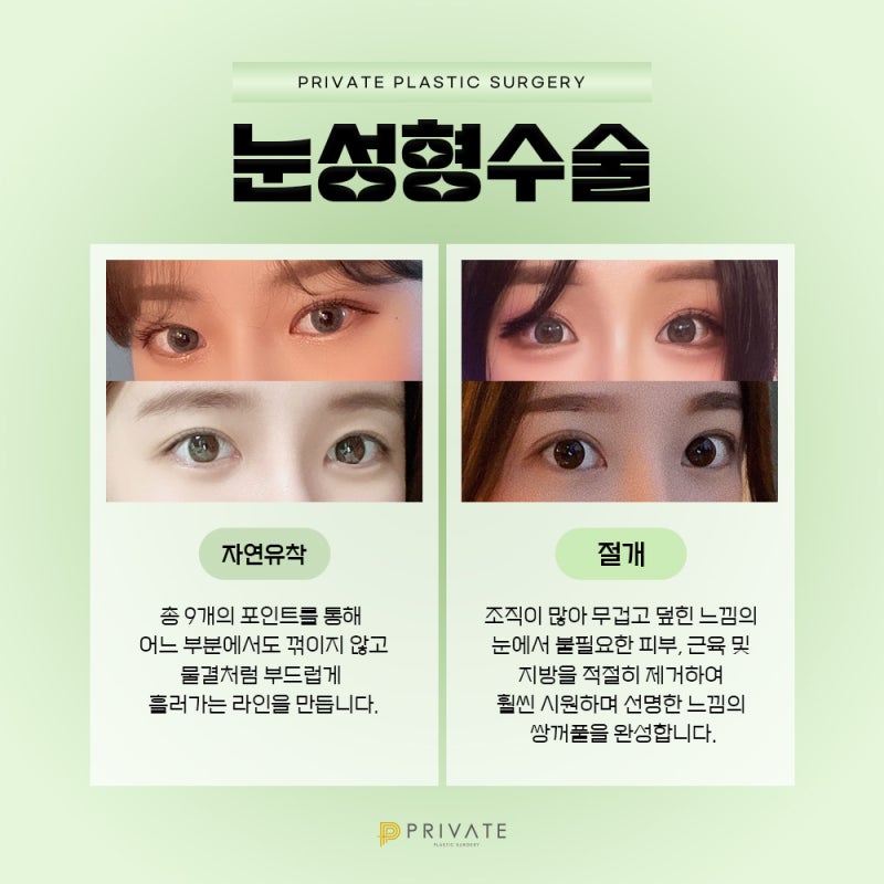 눈 쌍꺼풀 종류, 프라이빗성형외과에서 알아보자