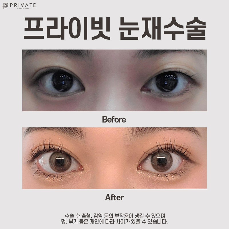 쌍수재수술후기 좋은 프라이빗성형외과 사진 8