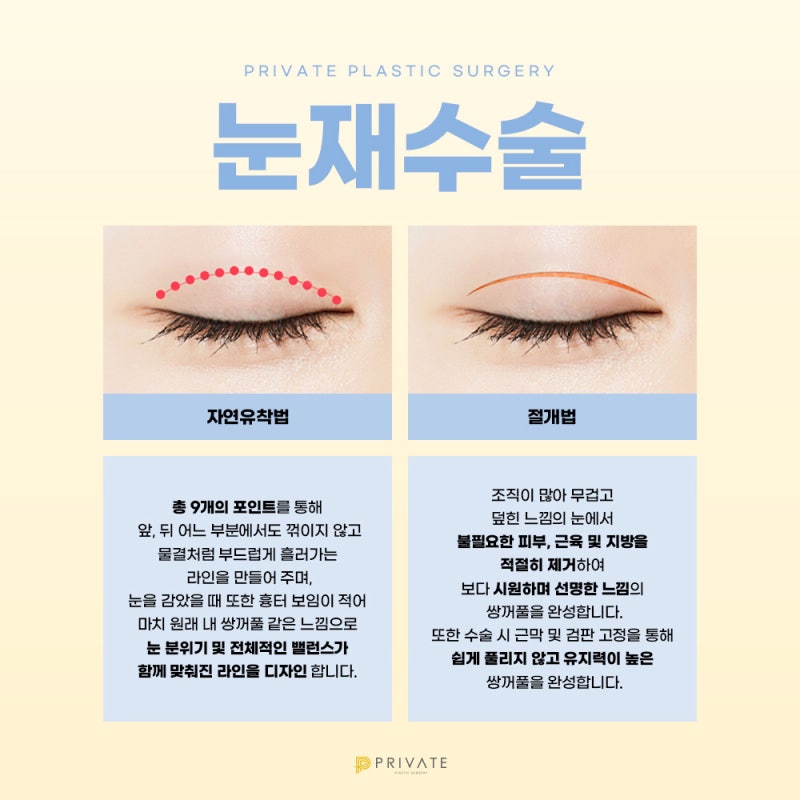 쌍수재수술후기 좋은 프라이빗성형외과 사진 4