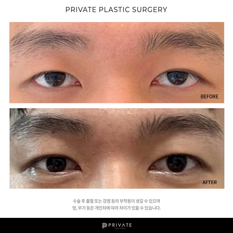 프라이빗성형외과, 남자 눈수술 잘하는 병원 사진 7