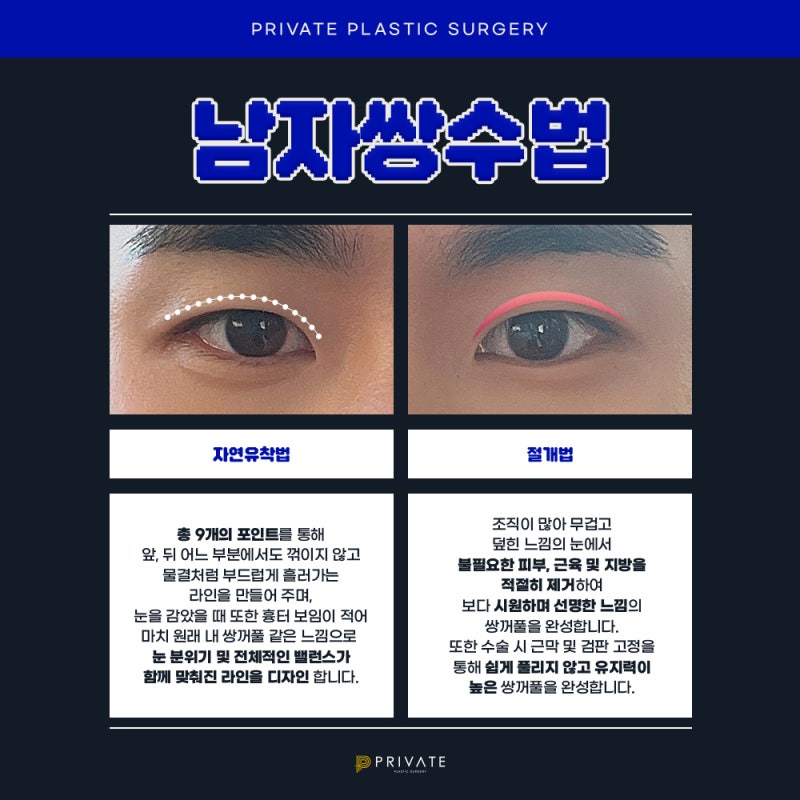 프라이빗성형외과, 남자 눈수술 잘하는 병원 사진 3