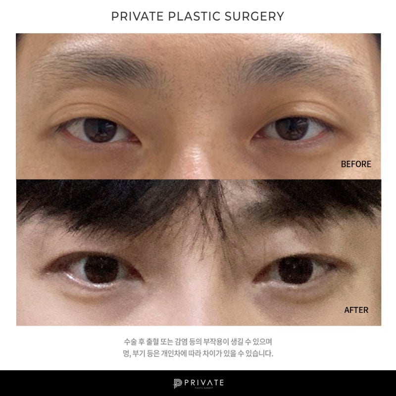 프라이빗성형외과, 남자 눈수술 잘하는 병원 사진 6