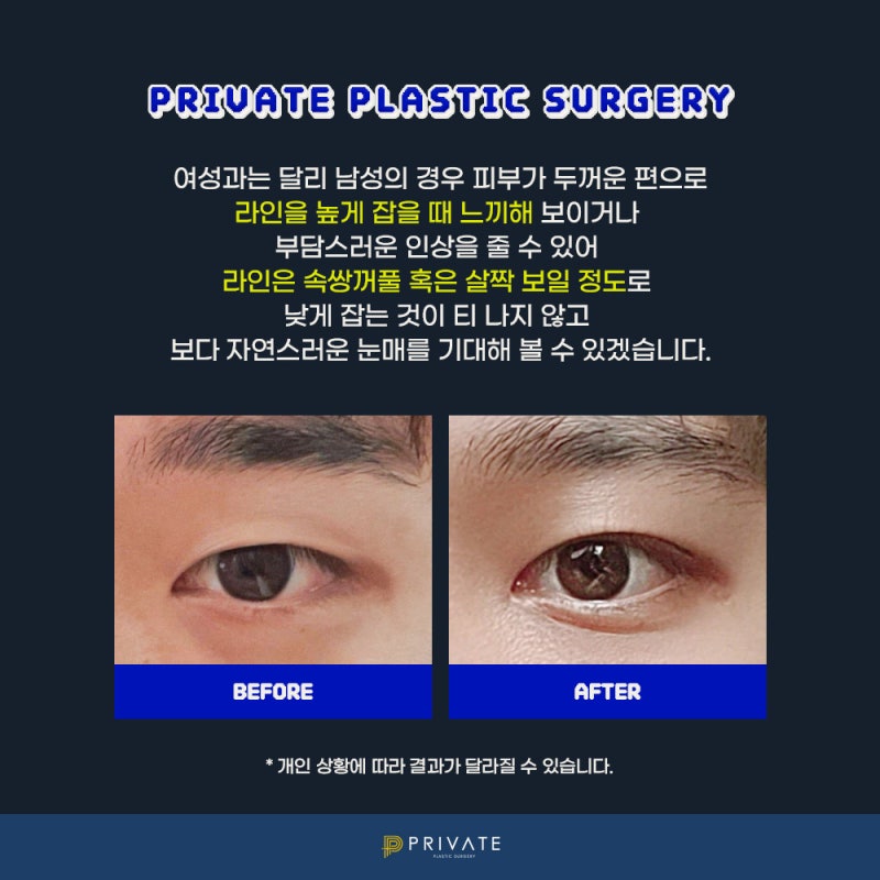 프라이빗성형외과, 남자 눈수술 잘하는 병원