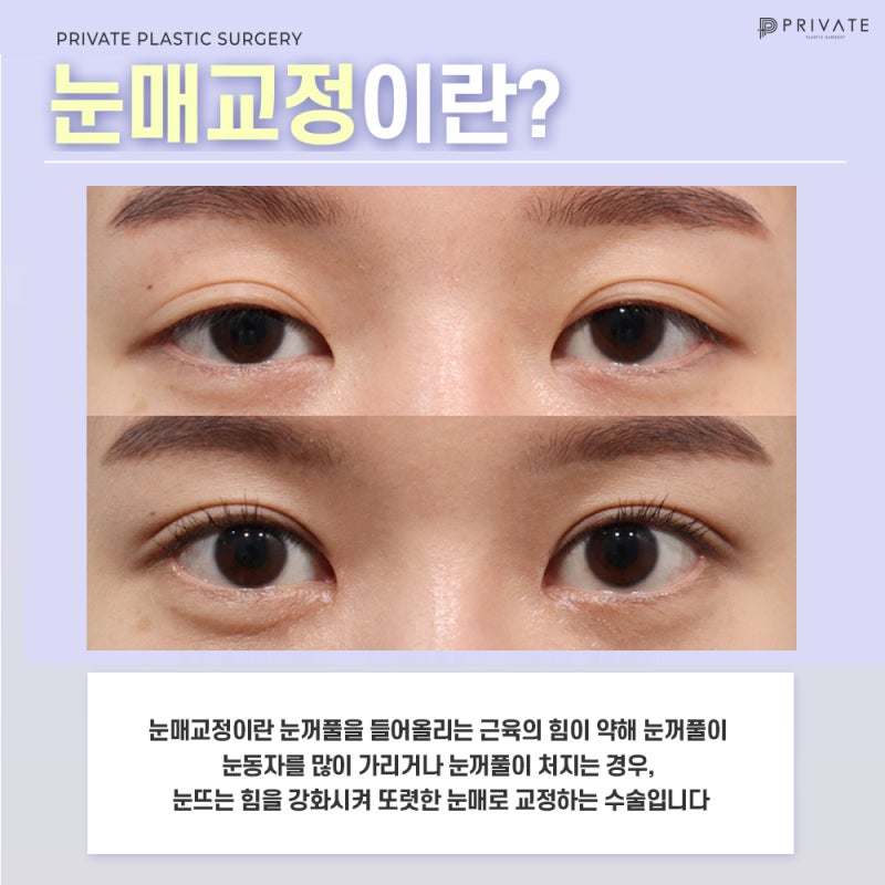 프라이빗성형외과 눈매교정수술전후가 궁금하다면?