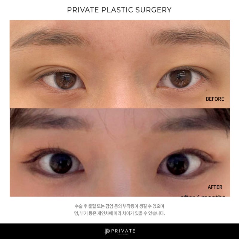 프라이빗성형외과 눈매교정수술전후가 궁금하다면? 사진 7