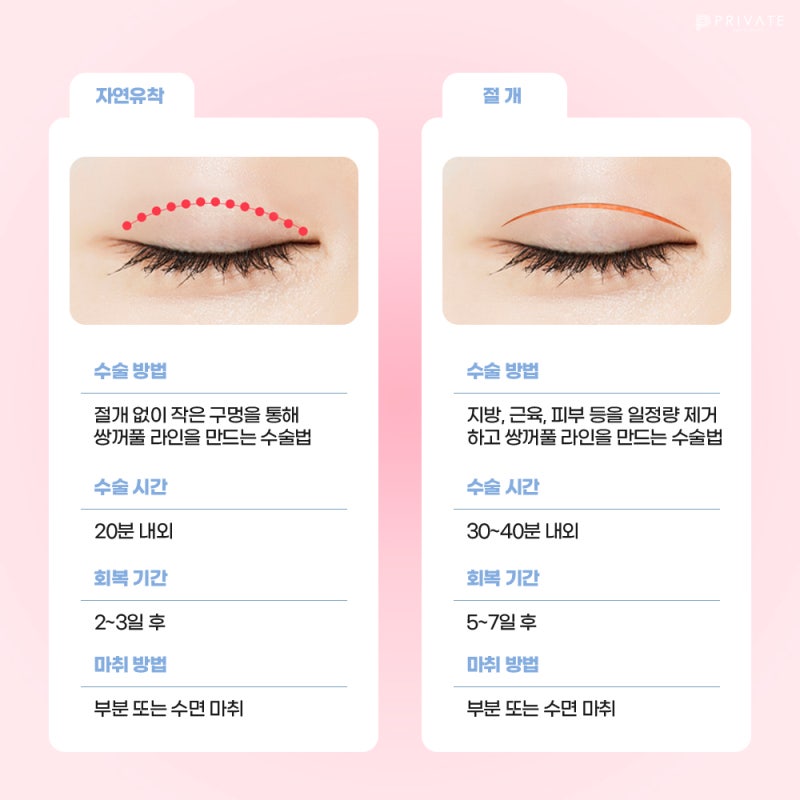 프라이빗성형외과, 쌍꺼풀수술 절개