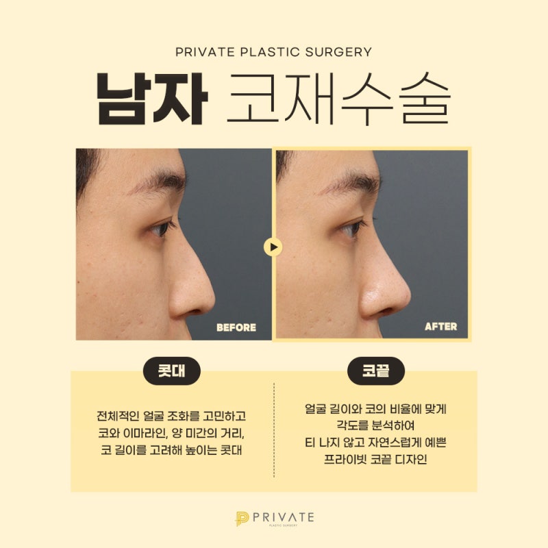 남자 코 재수술 잘하는곳은 신사역 프라이빗성형외과 사진 4