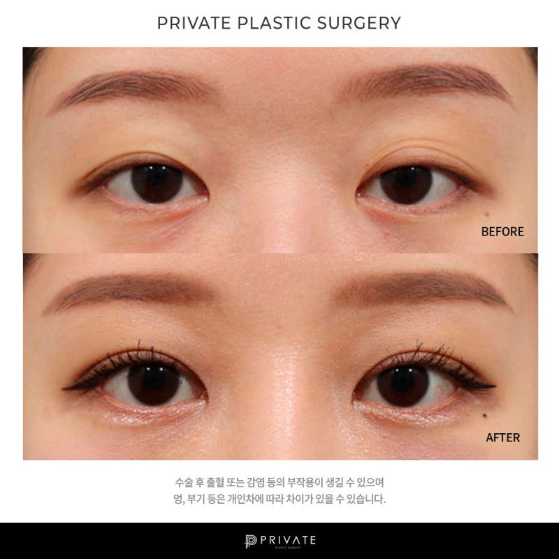 프라이빗 성형외과 쌍수후기는? 사진 8