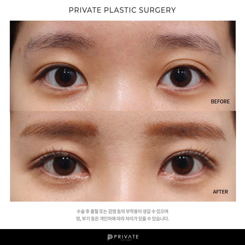 프라이빗 성형외과 쌍수후기는? 사진 7