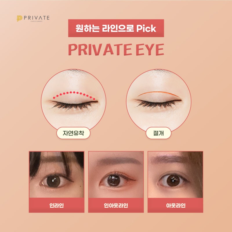 프라이빗성형외과 눈재수술 케이스 사진 3