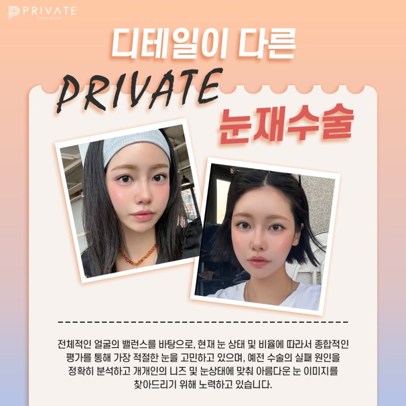 프라이빗성형외과 눈재수술 케이스