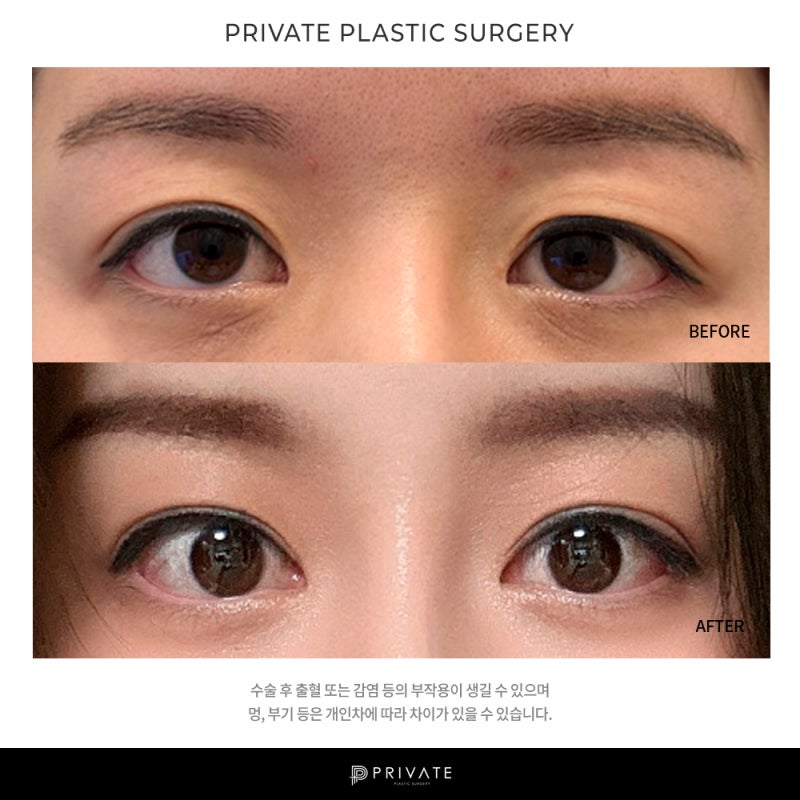 프라이빗성형외과 눈재수술 케이스 사진 7
