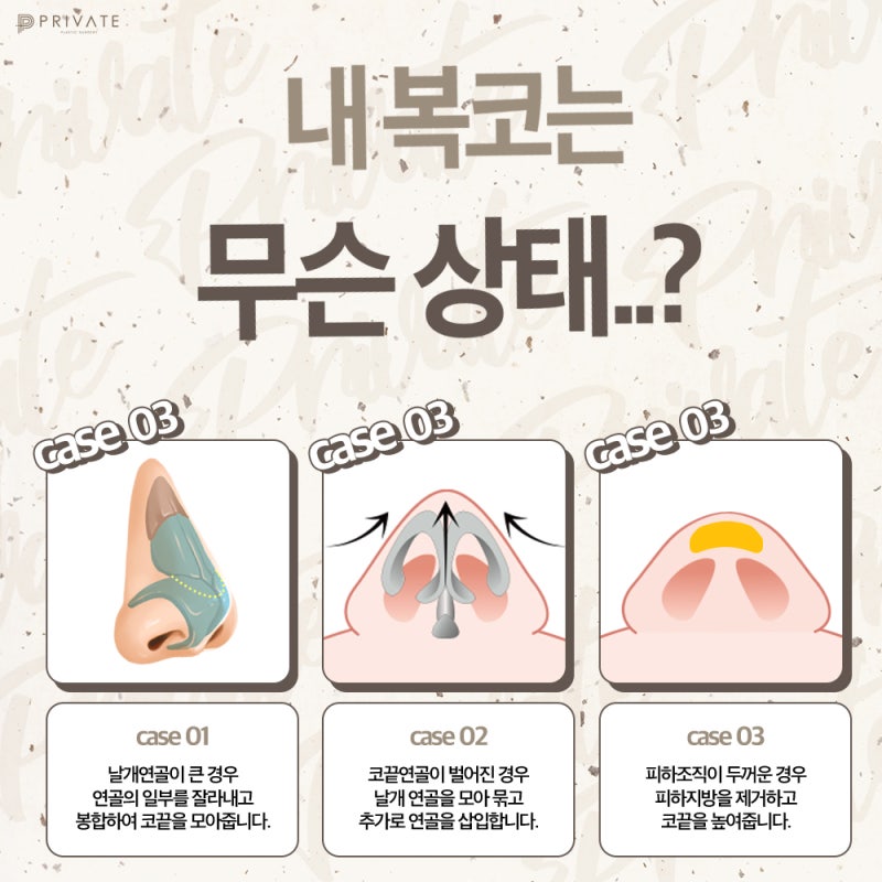 Dapatkan Garis Hidung yang Elegan dengan Operasi Rhinoplasty Hidung Babi Shinsa 사진 5
