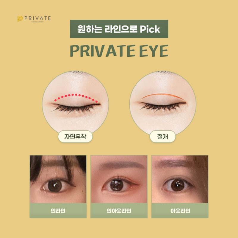 쌍꺼풀재수술잘하는곳에서 비율 맞추기 사진 4