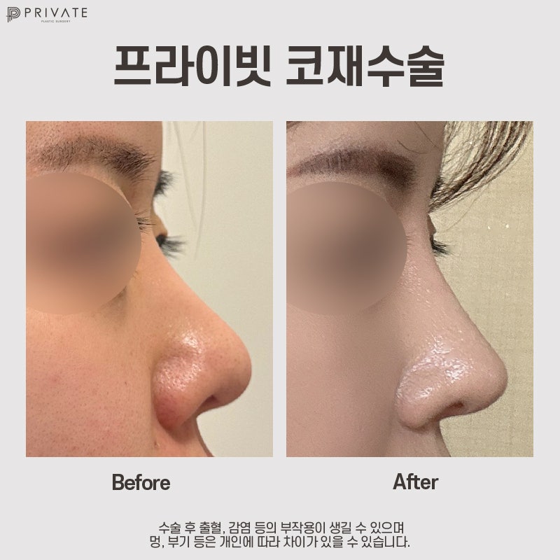 코재수술후기 프라이빗성형외과 사진 8
