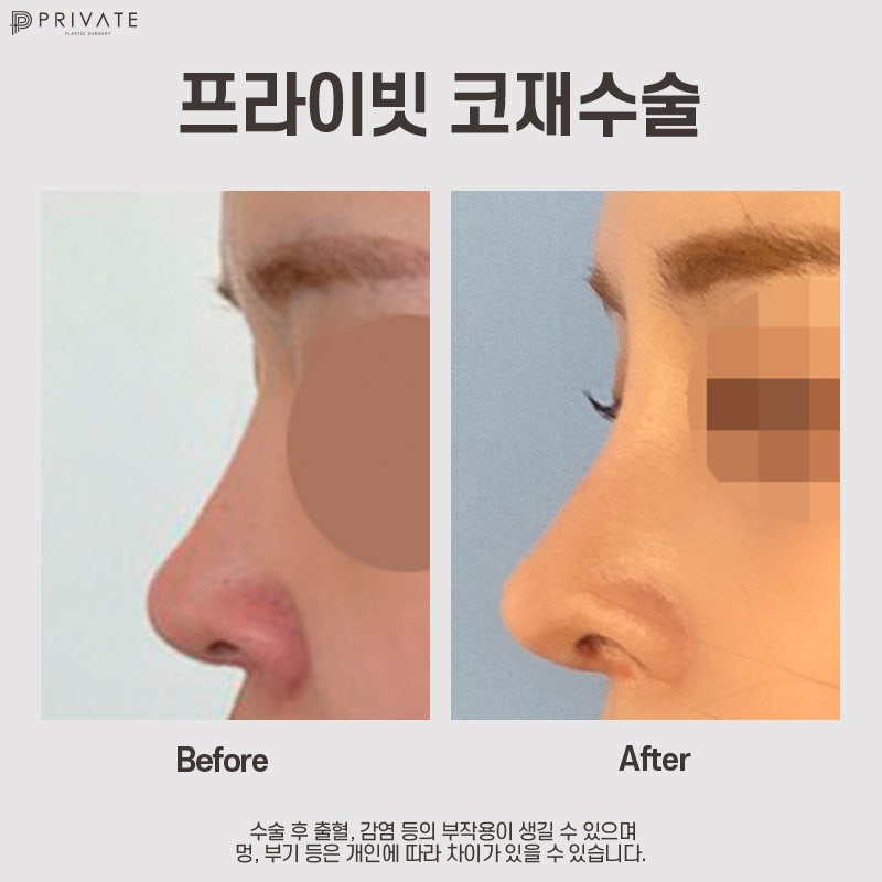 코재수술후기 프라이빗성형외과 사진 2