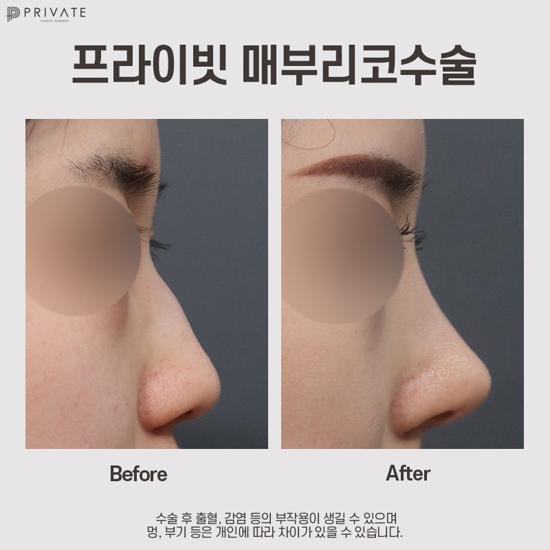 Operasi Hidung Bengkok di Private Plastic Surgery 사진 8
