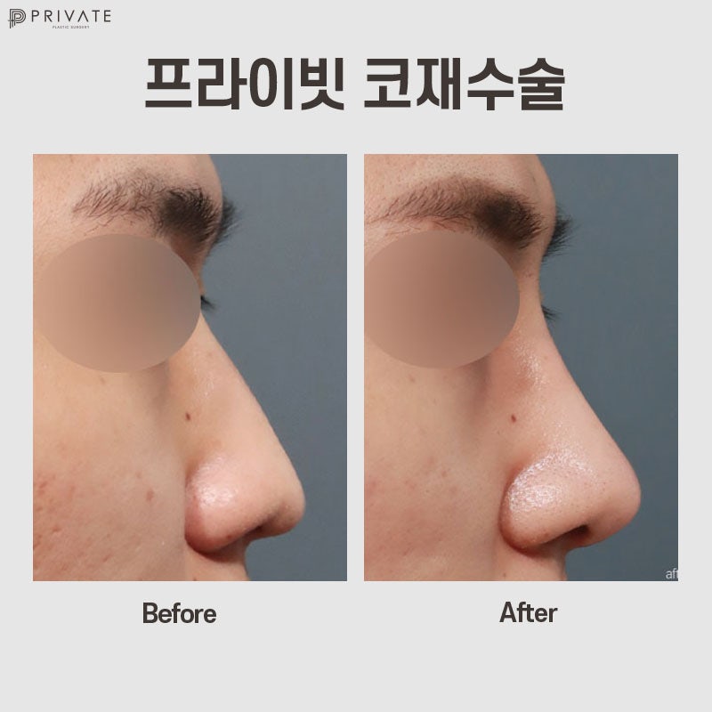 코재수술성형외과는 프라이빗성형외과 사진 9