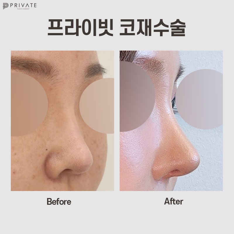 코재수술성형외과는 프라이빗성형외과 사진 2